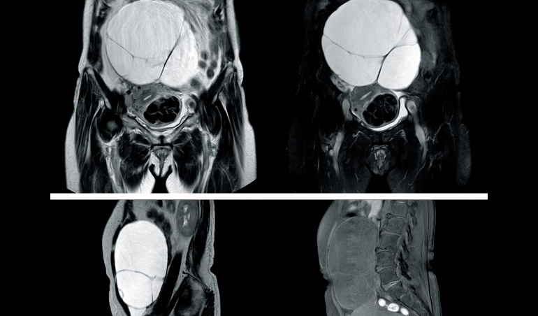 Resonancia de abdomen y pelvis